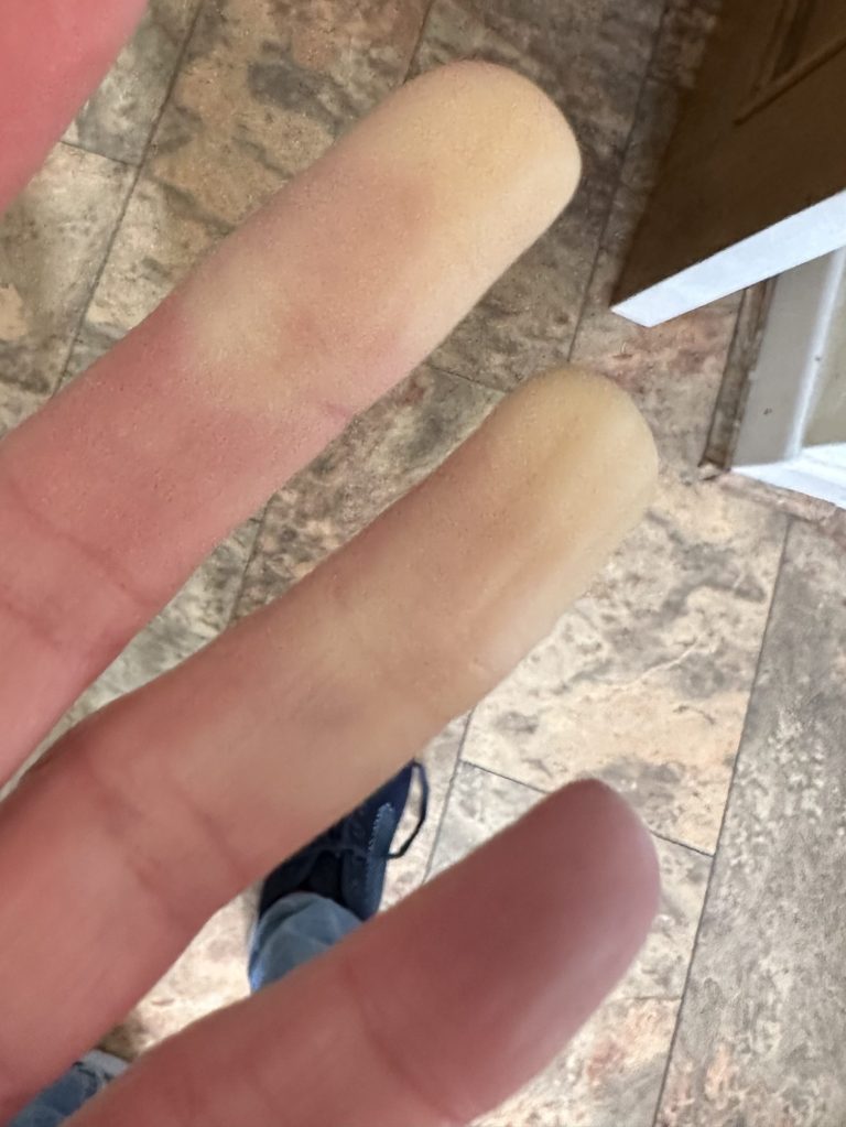 4 of my fingers, 2 of the tips are white, then a normal pinky colour at he bottom. The end finger is a slight purple. 